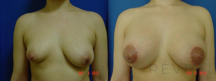 Before & After Breast Augmentation Case 99 View #1 View in San Jose, CA