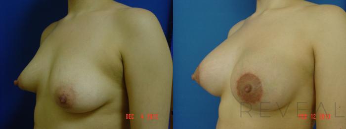 Before & After Breast Lift Case 99 View #2 View in San Jose, CA