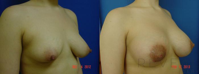 Before & After Breast Augmentation Case 99 View #3 View in San Jose, CA
