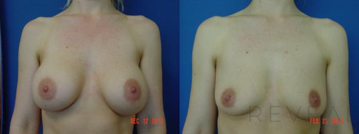 Before & After Breast Implants Case 102 View #1 View in San Jose, CA