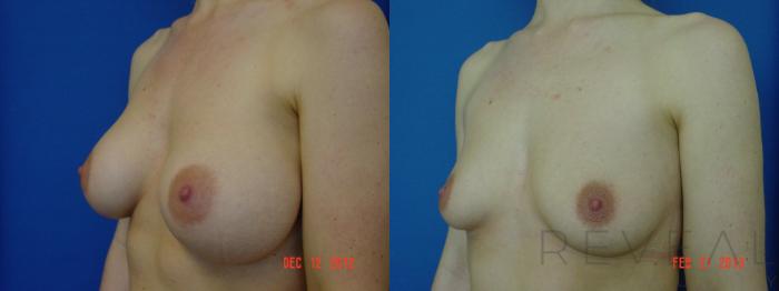Before & After Breast Implants Case 102 View #2 View in San Jose, CA