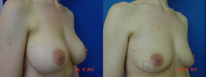Before & After Breast Implants Case 102 View #3 View in San Jose, CA