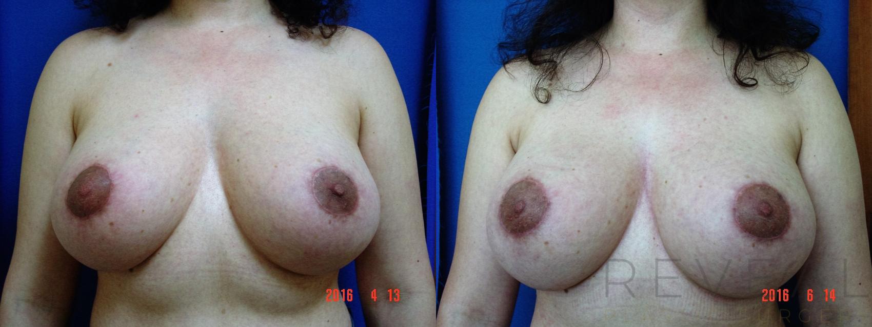 Before & After Breast Augmentation Case 191 View #1 View in San Jose, CA