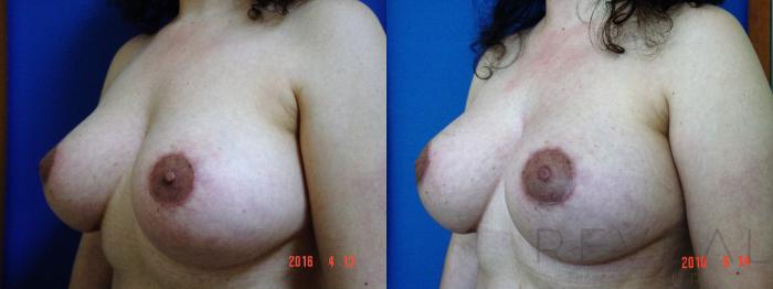 Before & After Breast Lift Case 191 View #3 View in San Jose, CA