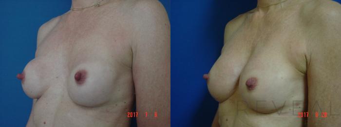 Before & After Breast Implants Case 223 View #1 View in San Jose, CA