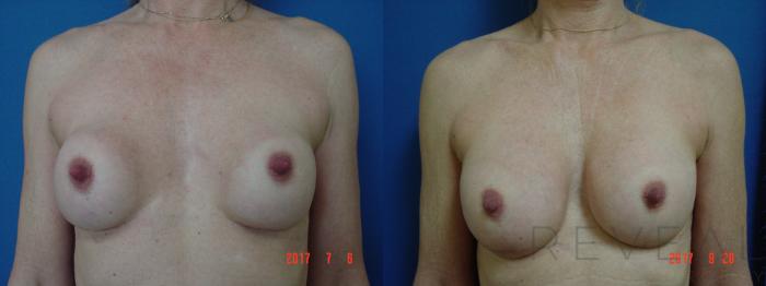 Before & After Breast Implants Case 223 View #2 View in San Jose, CA