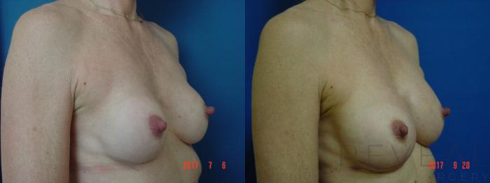 Before & After Breast Implants Case 223 View #3 View in San Jose, CA