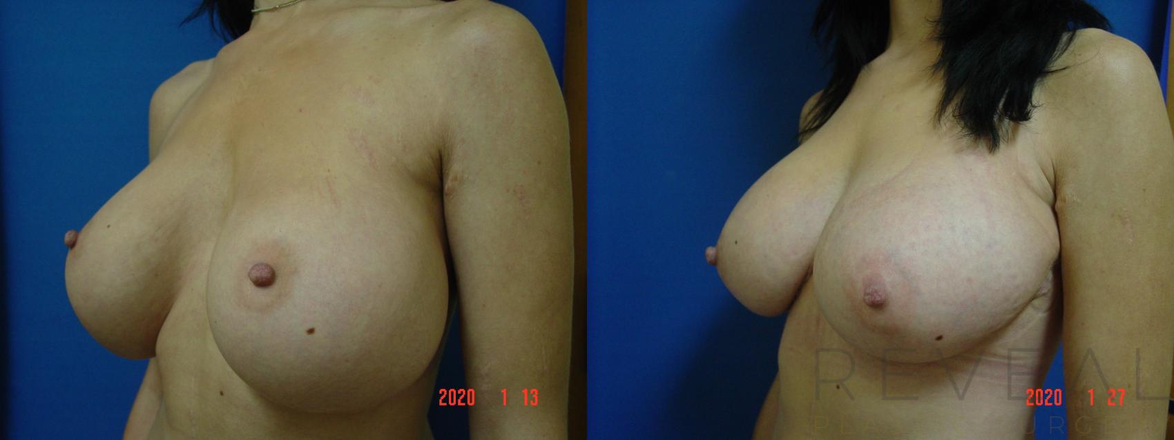 Before & After Breast Lift Case 388 View #2 View in San Jose, CA