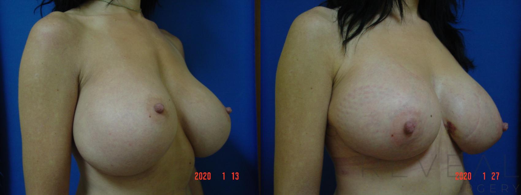 Before & After Breast Lift Case 388 View #3 View in San Jose, CA