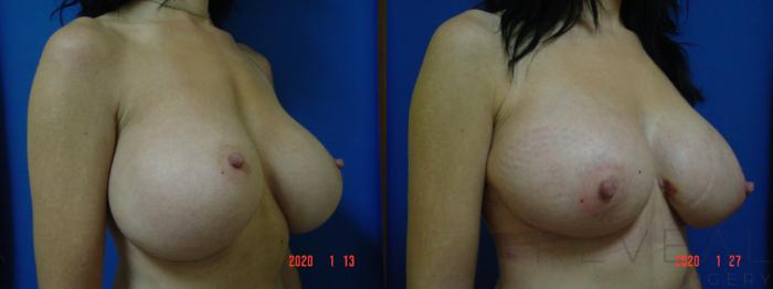 Before & After Breast Implants Case 388 View #3 View in San Jose, CA