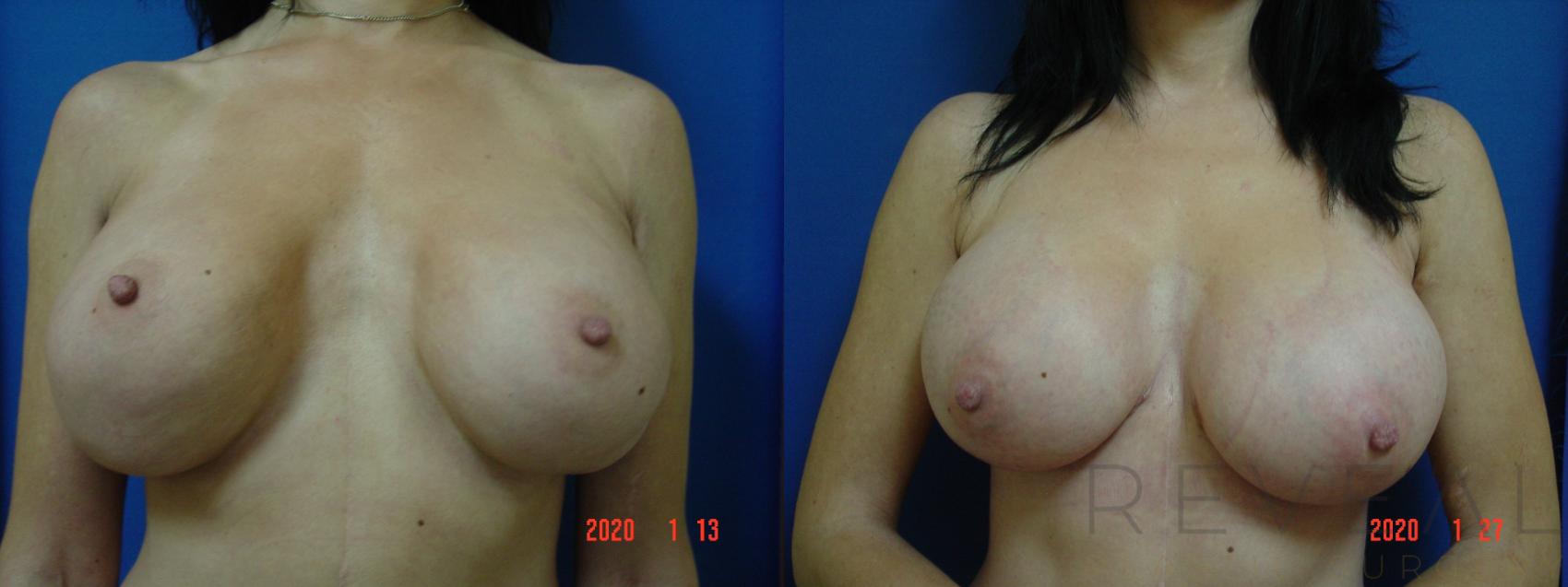 Before & After Breast Lift Case 388 View #4 View in San Jose, CA