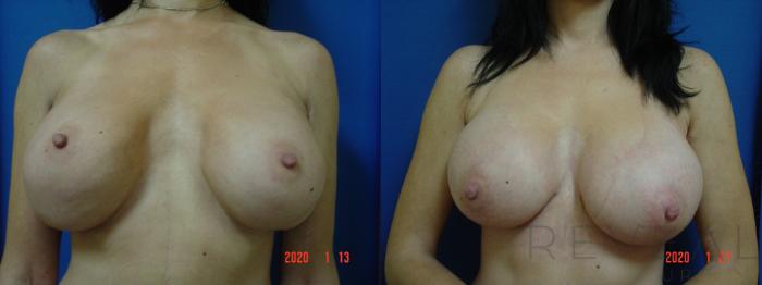Before & After Breast Implants Case 388 View #4 View in San Jose, CA