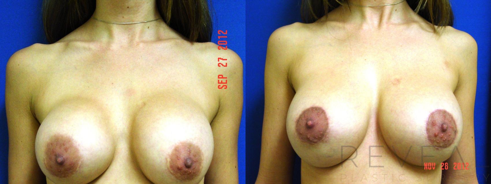 Before & After Breast Augmentation Case 94 View #1 View in San Jose, CA