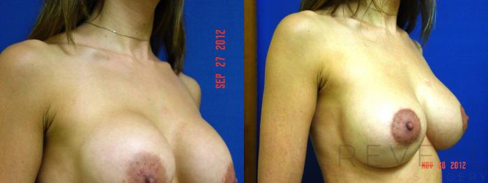 Before & After Breast Augmentation Case 94 View #2 View in San Jose, CA