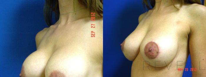 Before & After Breast Augmentation Case 94 View #3 View in San Jose, CA