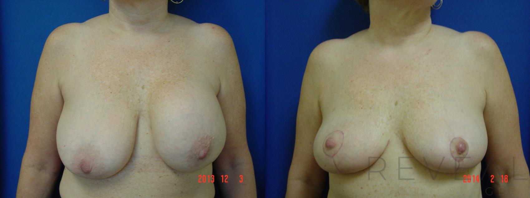 Before & After Breast Lift Case 131 View #1 View in San Jose, CA