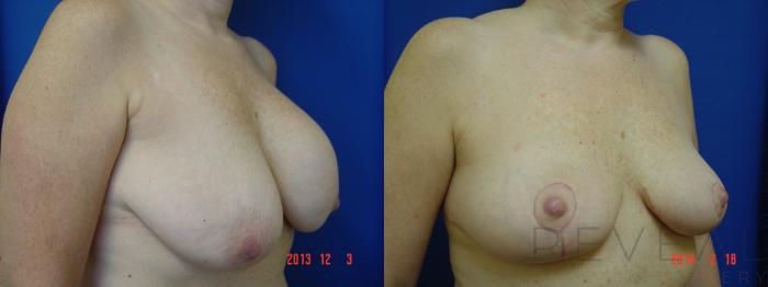 Before & After Breast Lift Case 131 View #2 View in San Jose, CA