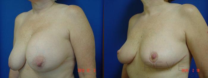 Before & After Breast Lift Case 131 View #3 View in San Jose, CA