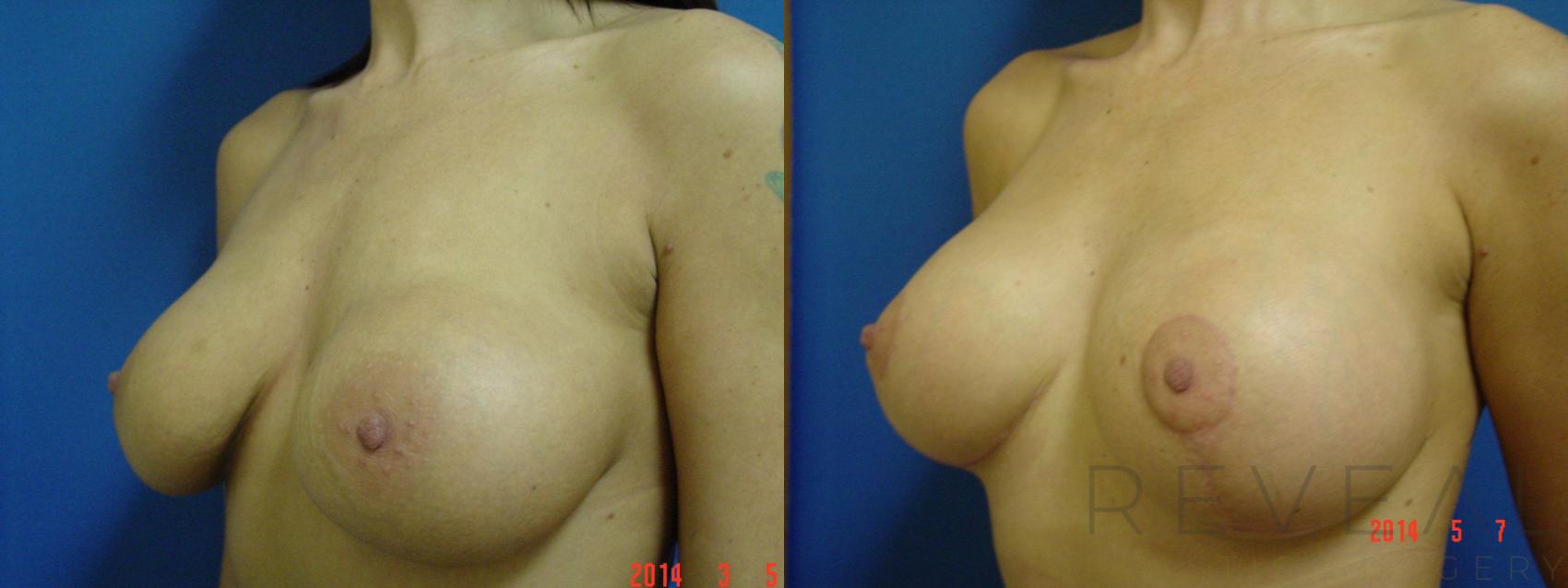 Before & After Breast Augmentation Case 138 View #1 View in San Jose, CA