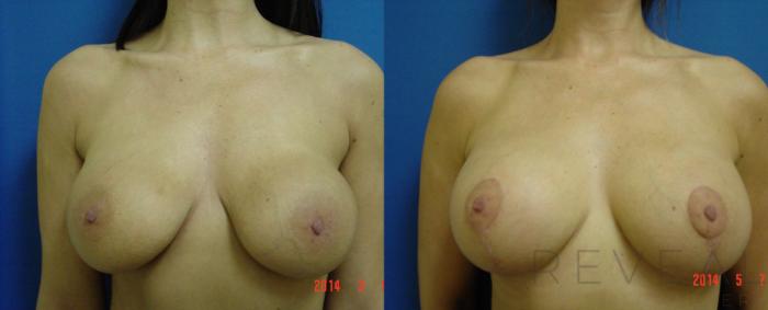Before & After Breast Lift Case 138 View #2 View in San Jose, CA