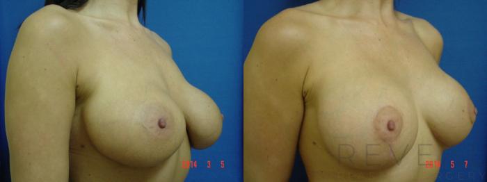 Before & After Breast Augmentation Case 138 View #3 View in San Jose, CA