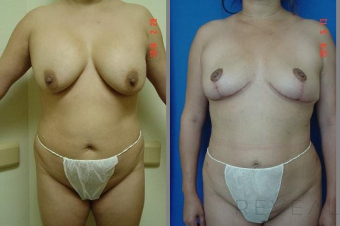 Before & After Liposuction Case 144 View #1 View in San Jose, CA