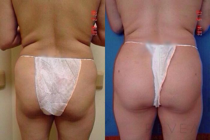 Before & After Brazilian Butt Lift Case 144 View #2 View in San Jose, CA