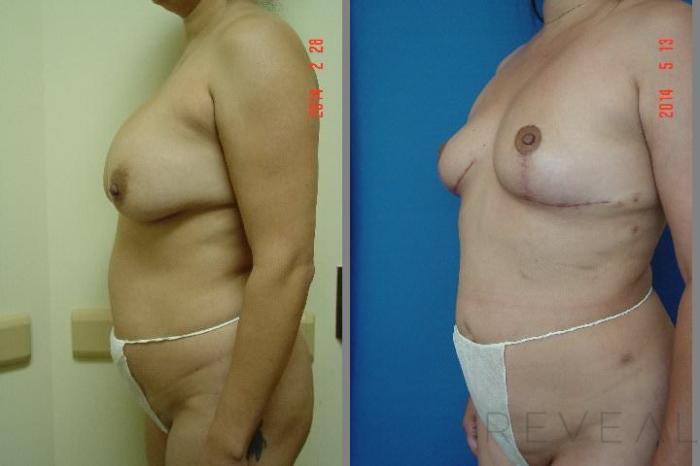 Before & After Liposuction Case 144 View #3 View in San Jose, CA