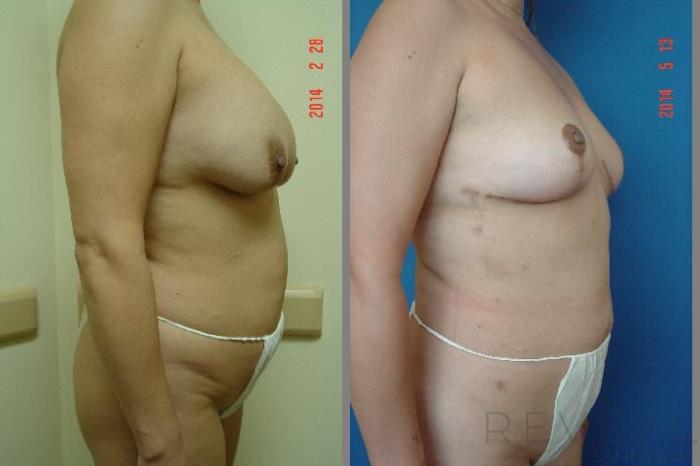 Before & After Liposuction Case 144 View #4 View in San Jose, CA