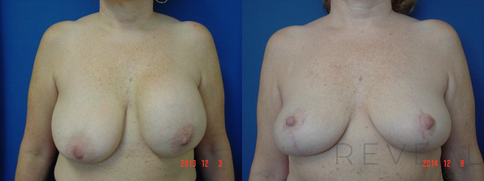 Before & After Breast Lift Case 166 View #1 View in San Jose, CA