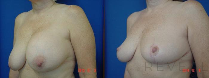 Before & After Breast Lift Case 166 View #2 View in San Jose, CA