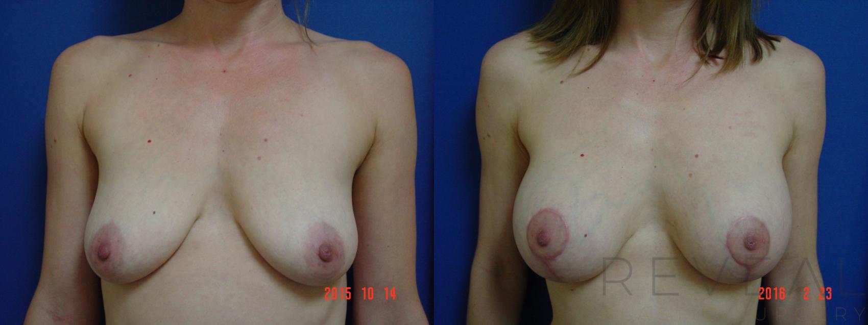 Before & After Breast Augmentation Case 187 View #1 View in San Jose, CA