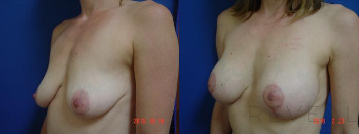 Before & After Breast Augmentation Case 187 View #2 View in San Jose, CA