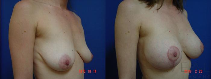 Before & After Breast Lift Case 187 View #3 View in San Jose, CA