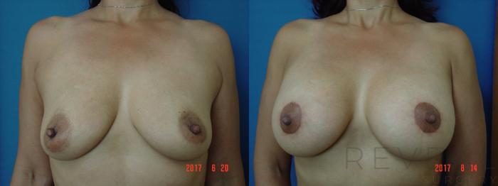Before & After Breast Lift Case 219 View #1 View in San Jose, CA