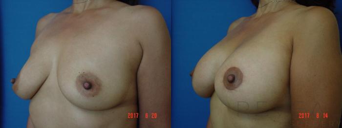 Before & After Breast Augmentation Case 219 View #2 View in San Jose, CA