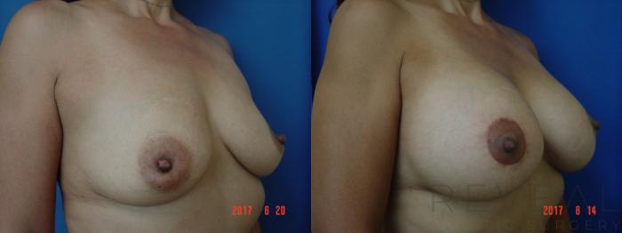 Before & After Breast Augmentation Case 219 View #3 View in San Jose, CA