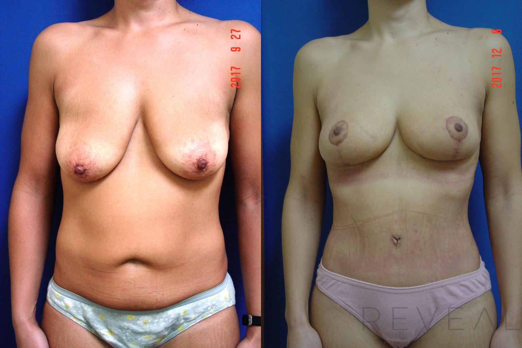 Before & After Tummy Tuck Case 229 View #1 View in San Jose, CA