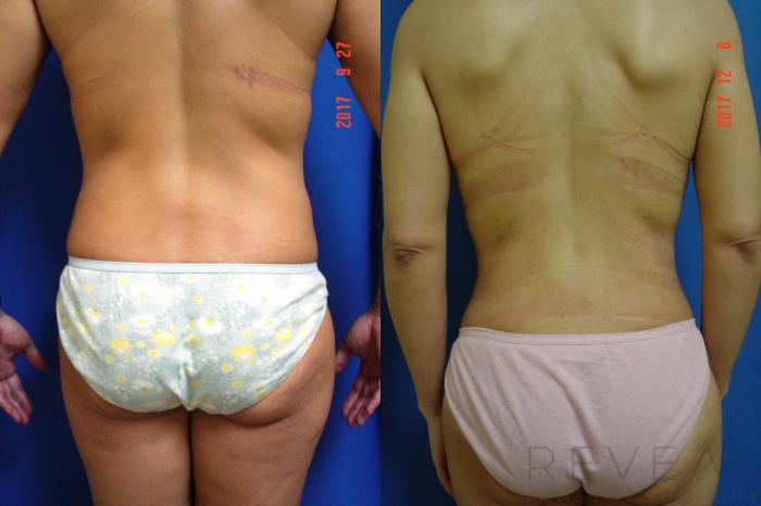 Before & After Tummy Tuck Case 229 View #2 View in San Jose, CA