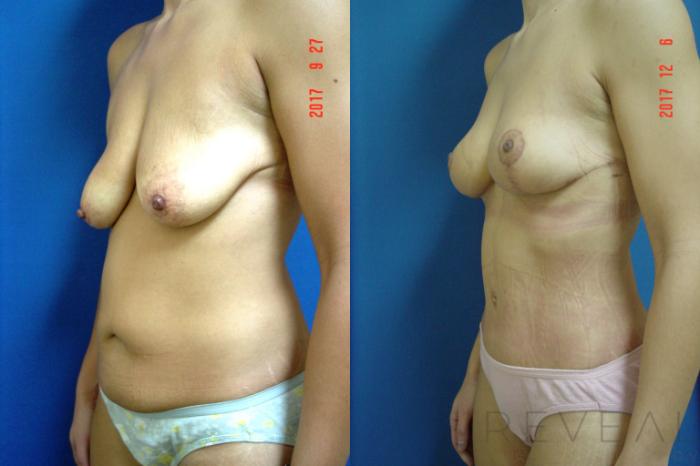 Before & After Breast Lift Case 229 View #3 View in San Jose, CA