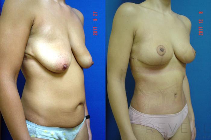 Before & After Breast Lift Case 229 View #4 View in San Jose, CA