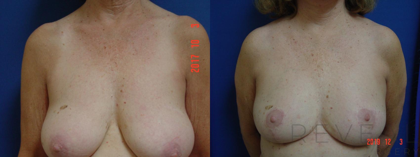 Before & After Breast Lift Case 378 View #1 View in San Jose, CA