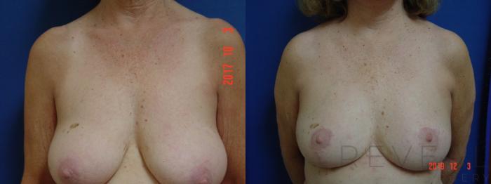 Before & After Breast Lift Case 378 View #1 View in San Jose, CA