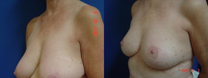 Before & After Breast Lift Case 378 View #2 View in San Jose, CA