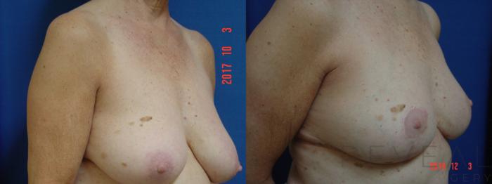 Before & After Breast Lift Case 378 View #3 View in San Jose, CA