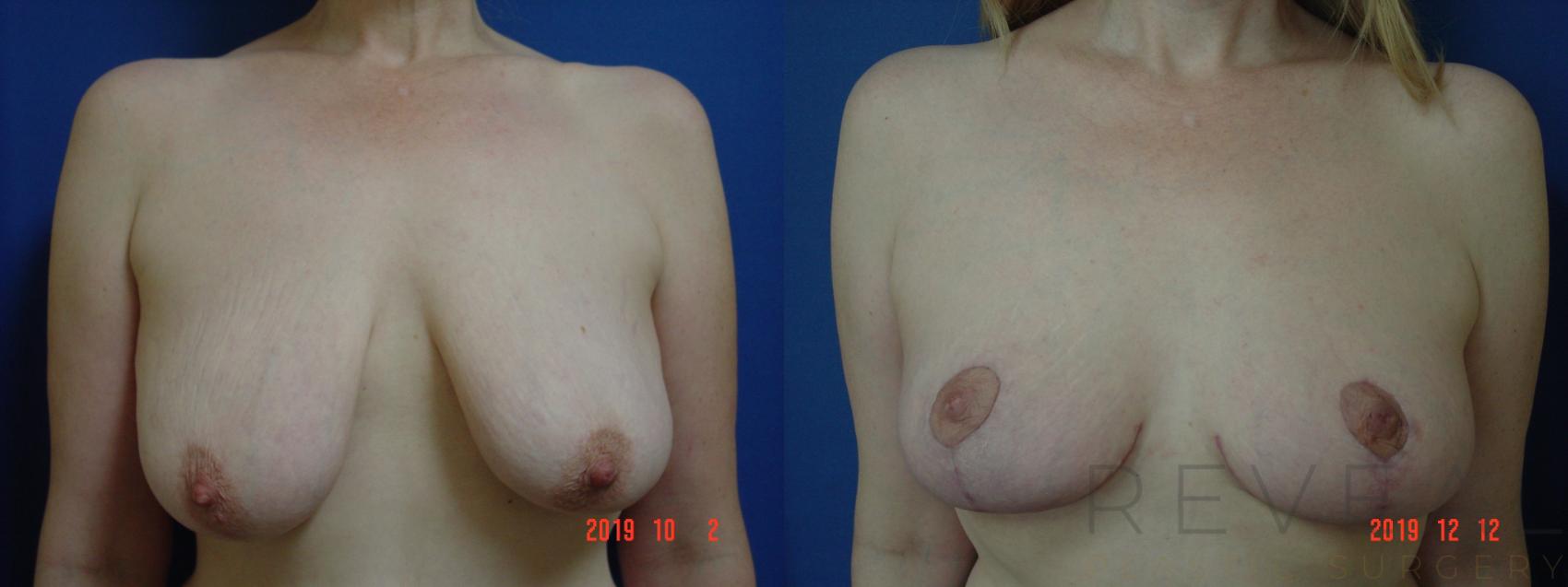 Before & After Breast Lift Case 382 View #1 View in San Jose, CA