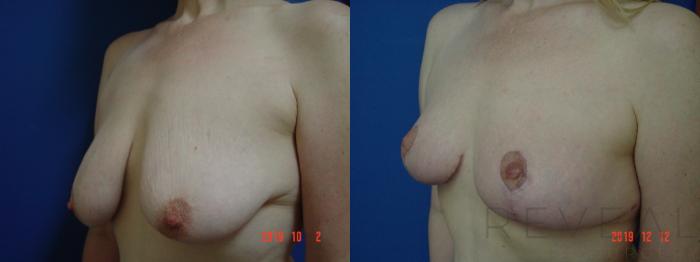 Before & After Breast Lift Case 382 View #2 View in San Jose, CA