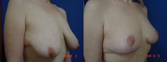 Before & After Breast Lift Case 382 View #3 View in San Jose, CA