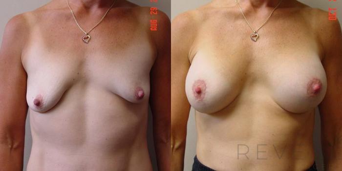 Before & After Breast Augmentation Case 4 View #1 View in San Jose, CA