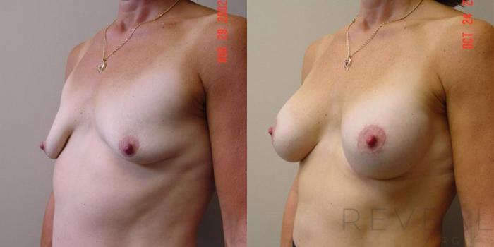 Before & After Breast Augmentation Case 4 View #2 View in San Jose, CA